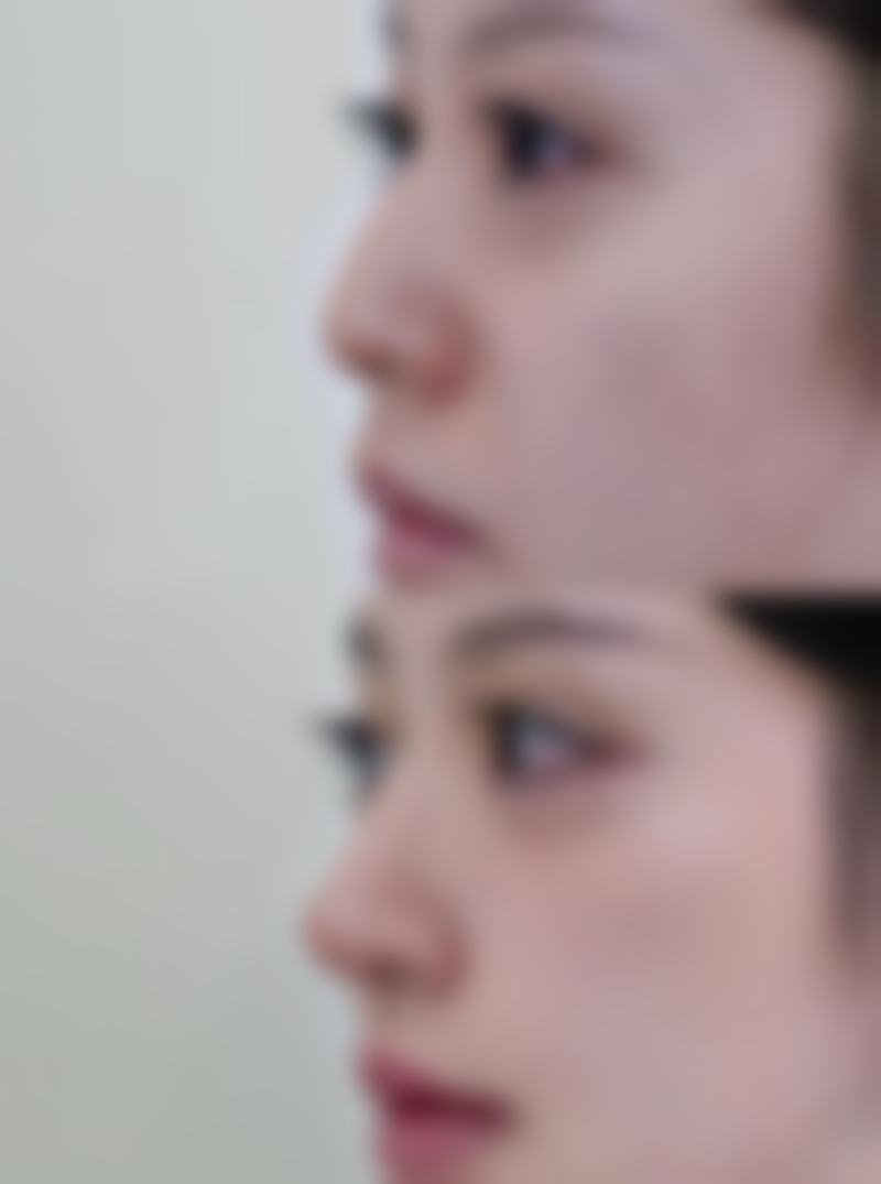 理性看待成都素美李建刚无痕筋膜提升3.0的风险