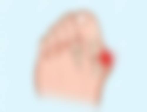 隆鼻山根高怎么办之3种修复方法