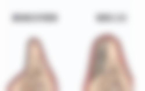 打完瘦脸针做美容可能产生的影响