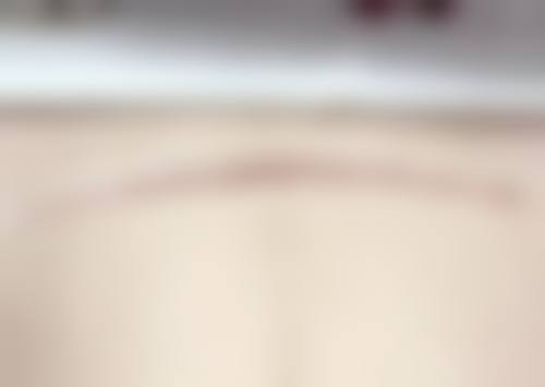 疤痕疙瘩怎么治疗能去根——昆明昆大疤痕医院