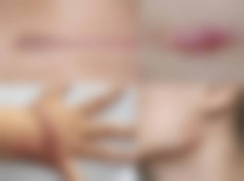 祛痣增生疤痕怎么才能去除——昆明昆大疤痕医院