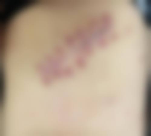 疤痕疙瘩怎么治疗能去根——黑龙江艺星医疗美容医院