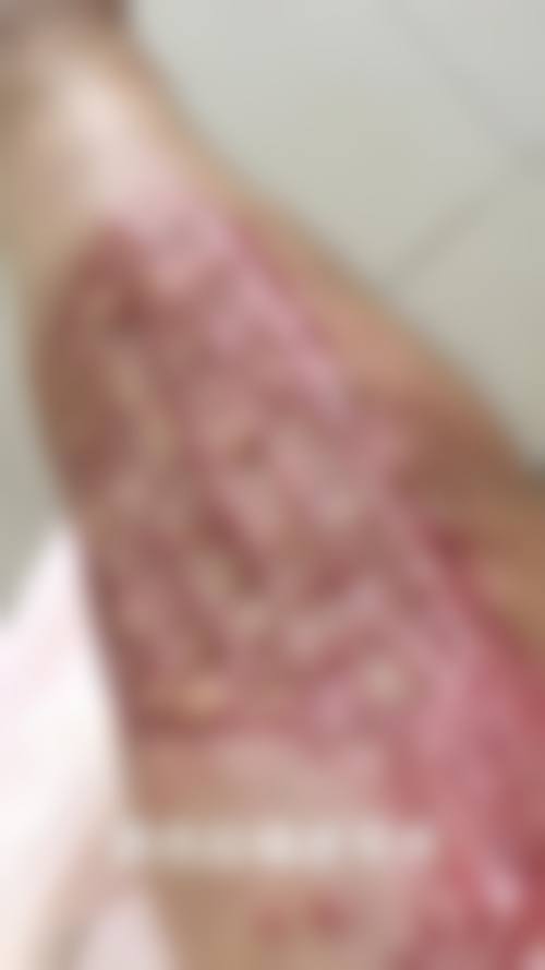 疤痕疙瘩怎么治疗能去根——哈尔滨医 科 大学附属第一医院整形美容科