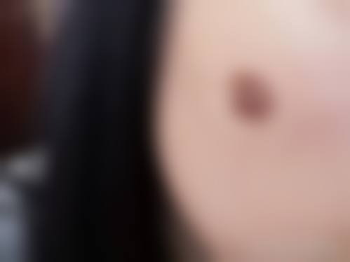 疤痕疙瘩怎么治疗能去根——福州玛恩皮肤医院