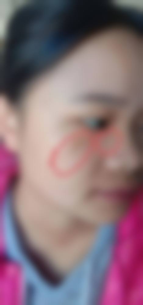 祛痣增生疤痕怎么才能去除？成都军建多疗法1780元起可预约