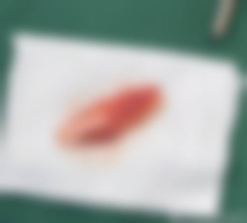 隆鼻后鼻头多久修复——杭州艺星医疗美容医院