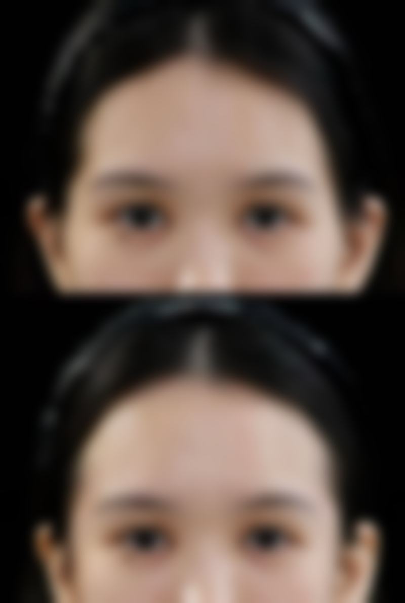 是埋线双眼皮好还是割好不好之修复时间对决：快速修复与耐心等待的选择