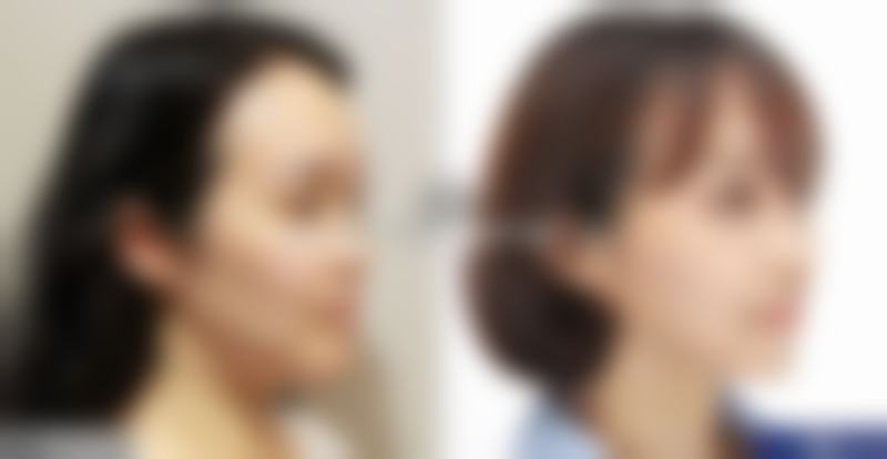 涂抹丰太阳穴成效能维持多久？残酷现实大揭露