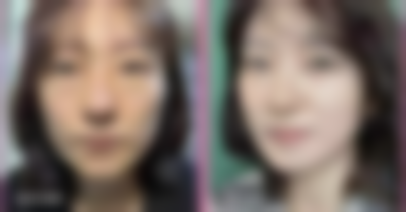 抽脂后一周可以见成效吗：肿胀初期的微妙变化