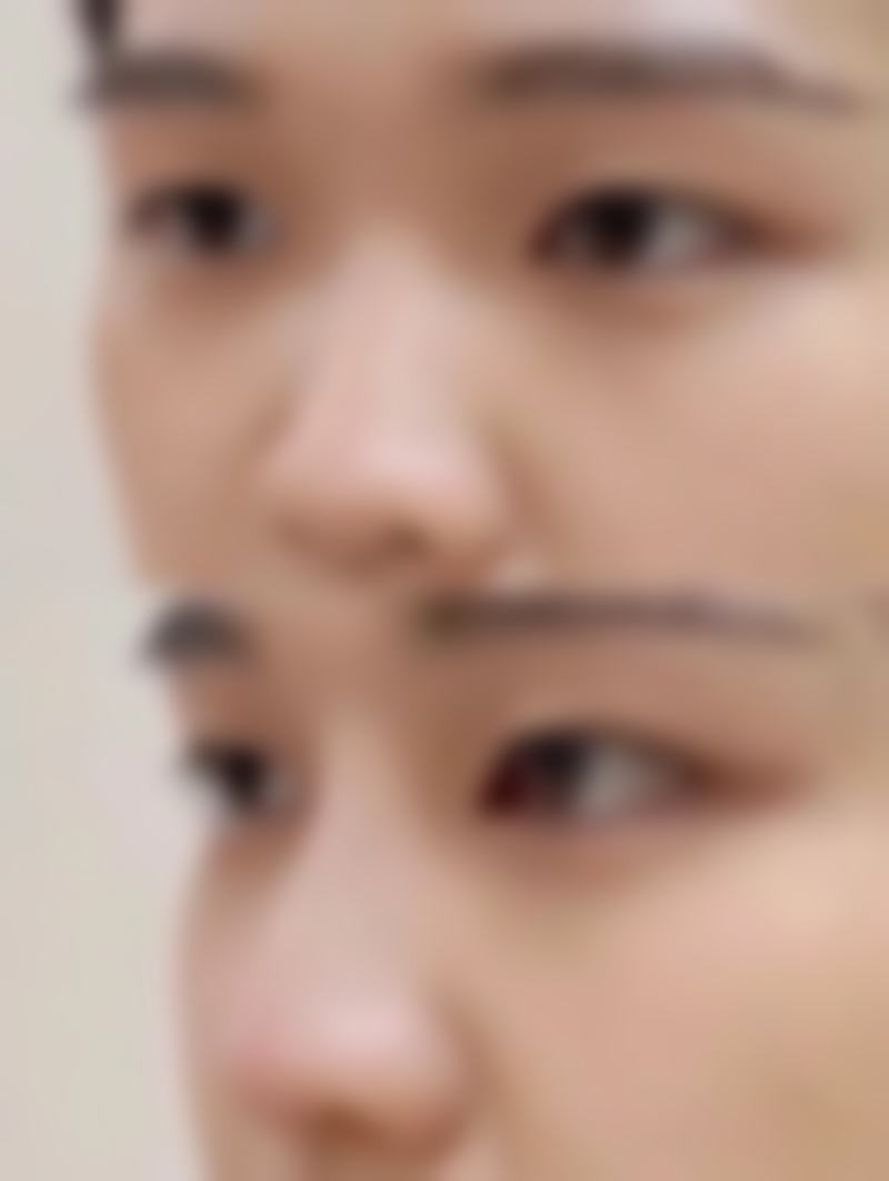 隆鼻后鼻头多久恢复？看术式差异+真人案例，周诚/齐一帆解析