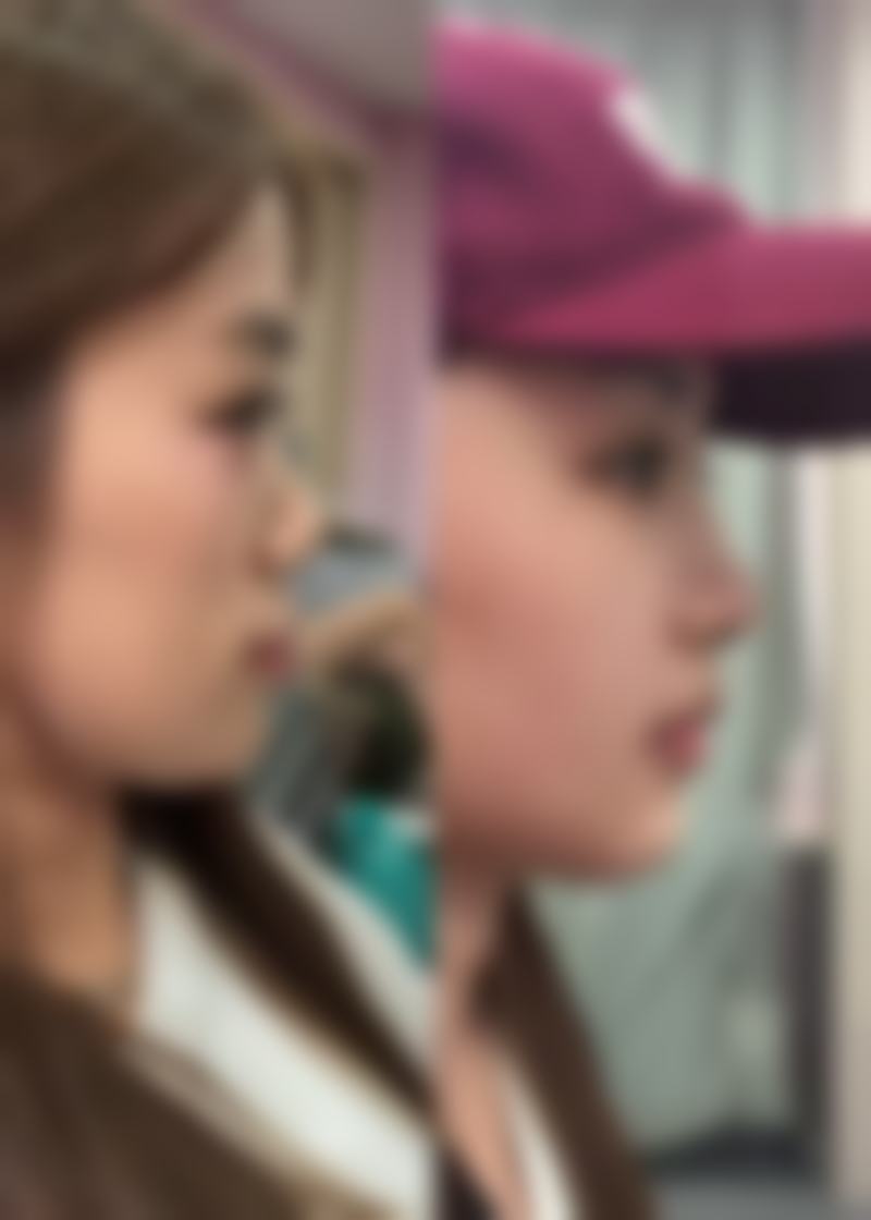 广州番禺阳光整形美容医院——韩风隆鼻特色