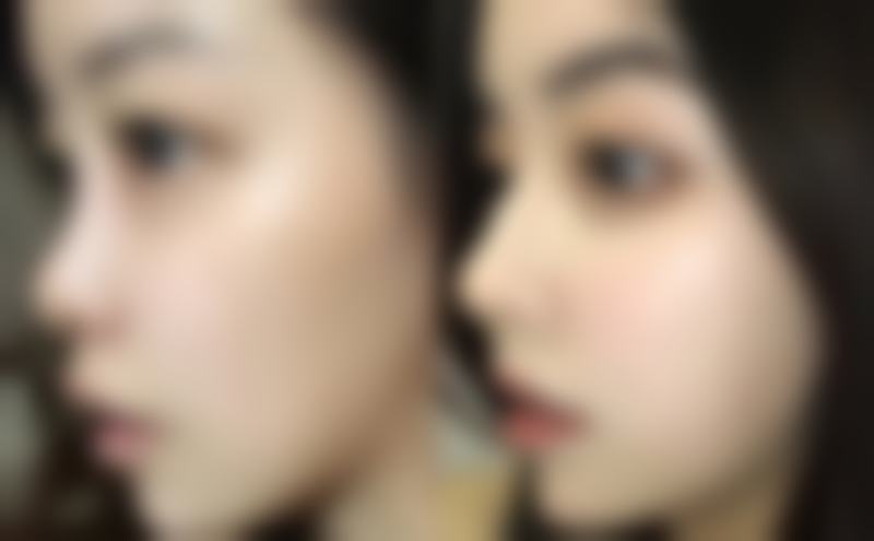 疤痕修复的常见误区：指甲抠的疤痕避开错误陷阱