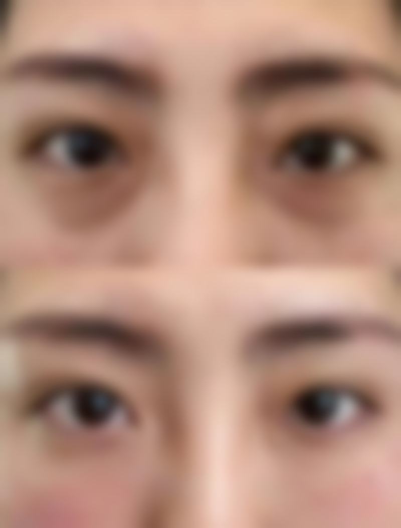 隆鼻山根高怎么办之日常护理要点