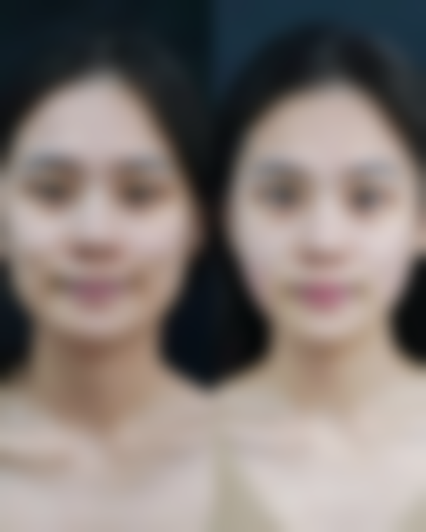 隆鼻后鼻头多久修复——昆明美伊莱整形医院