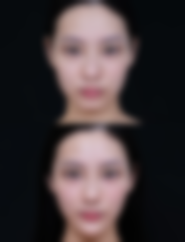 隆鼻后鼻头多久修复——广州中家医家庭医生医疗美容医院