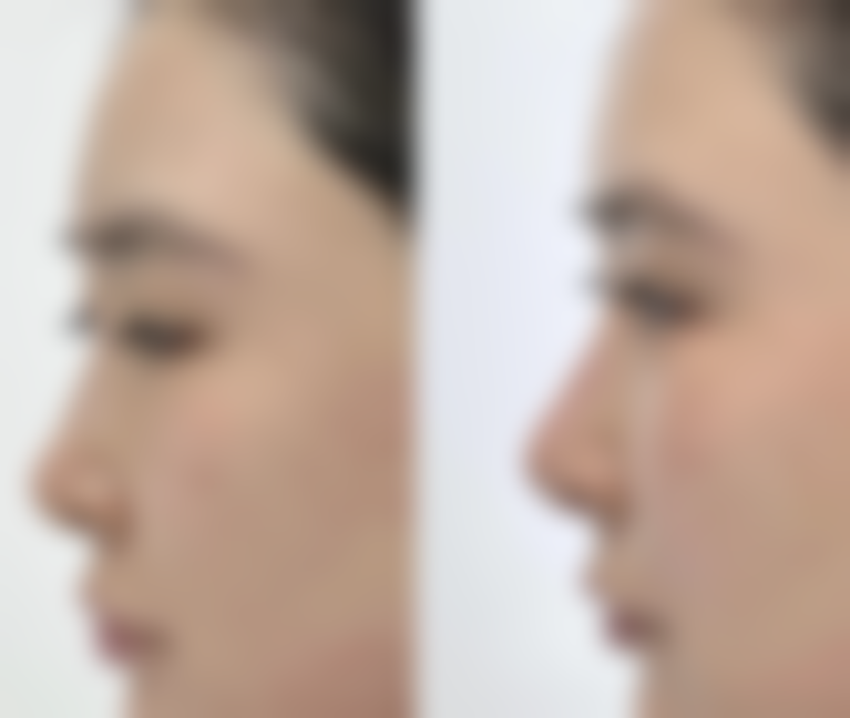 隆鼻后鼻头多久修复——盐城东方女子整形医院