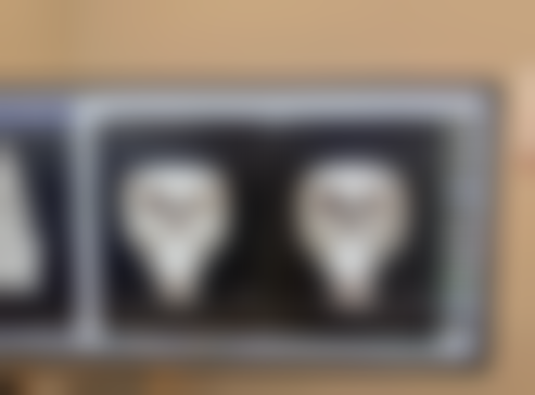 抽脂后一个月可以见成效吗：肿胀消退与线条初显