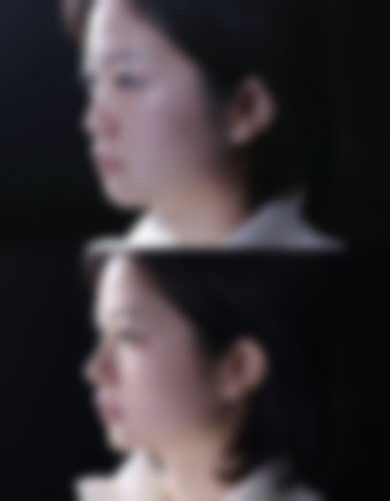 瘦脸针多久可以出成效之瘦脸针成效的时间线：从初见成效到巅峰状态