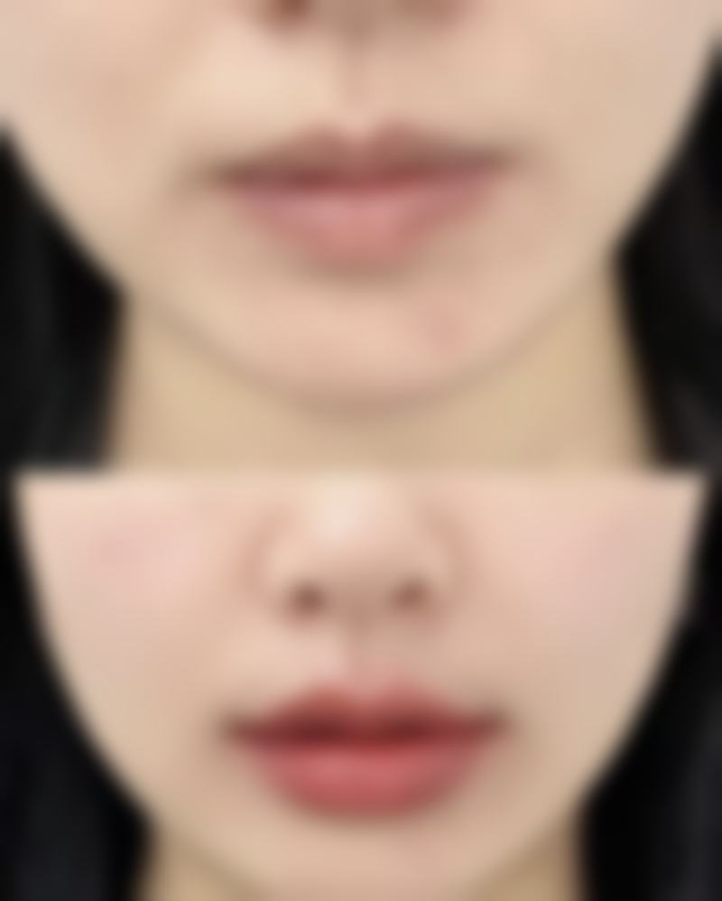 腿部抽脂后多久可以见成效：筷子腿养成记