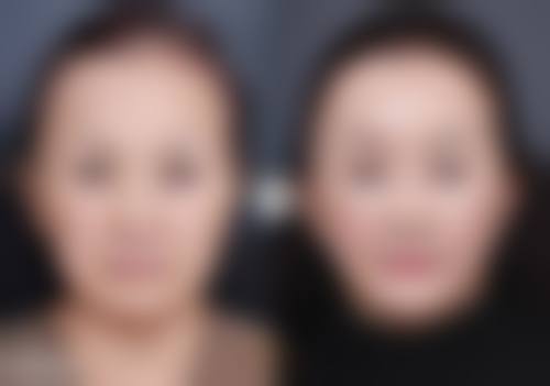 假体隆胸可以用力抓吗——用力抓带来的多重影响