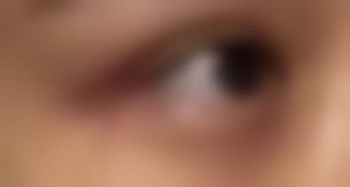 割双眼皮形成明显疤痕能修复吗