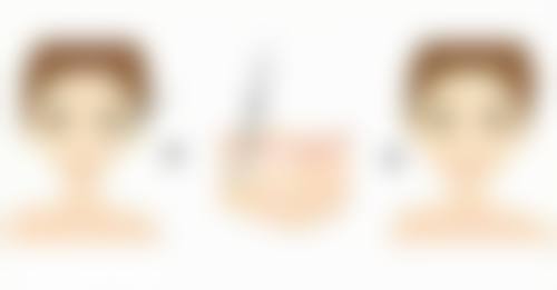 什么办法可以淡化缝针疤痕之激光治疗：精细打击疤痕的终极武器