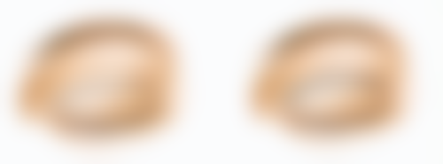 打瘦脸针脸肿如何缓解