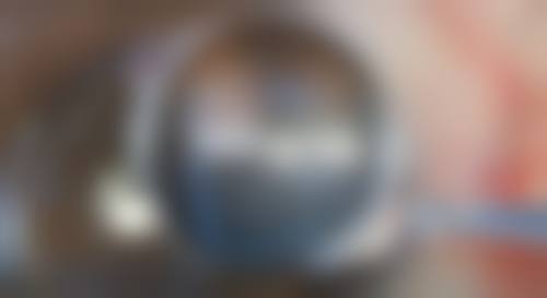 割双眼皮修复方案该怎么选择呢