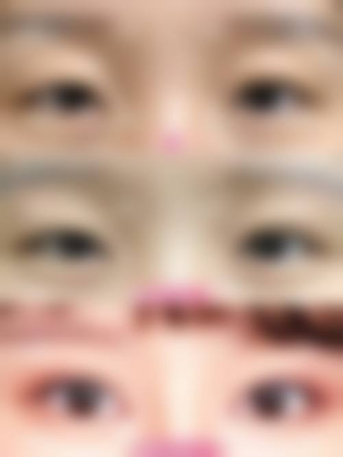 眼皮厚适合哪种双眼皮——上海伯思立医疗美容门诊部