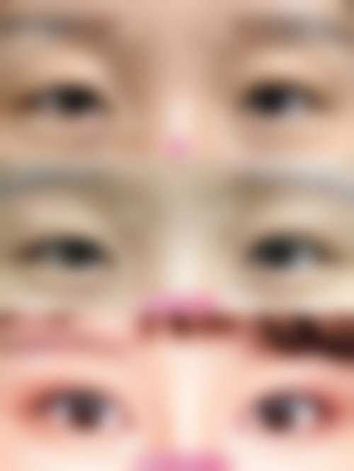 怎么把眼睛睡成双眼皮——成都华颜医疗美容医院