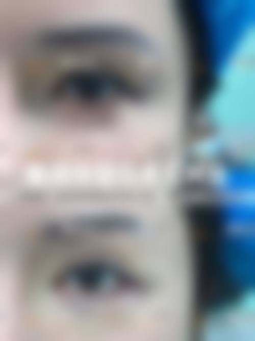 怎么把眼睛睡成双眼皮——北京画美医院
