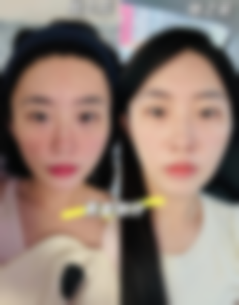 如何更有效的去眼袋，手术+激光双管齐下，告别松弛脂肪