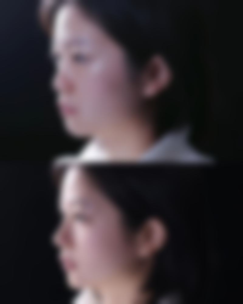 二、3岁小孩脸上烫伤疤痕慢慢修复的可能性分析