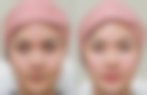 眼皮厚适合哪种双眼皮？全切、日式无痕双眼皮适配性更高更自然