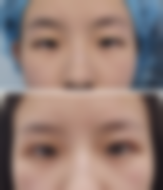 眼皮厚适合哪种双眼皮——广东画美医疗美容医院