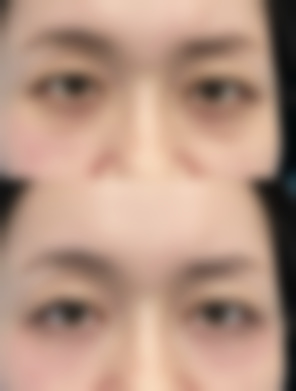 眼皮厚适合哪种双眼皮——高毅明医生所在医院