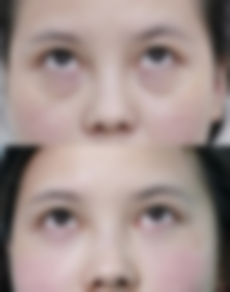 眼皮厚适合哪种双眼皮——韩国大眼睛整形外科医院