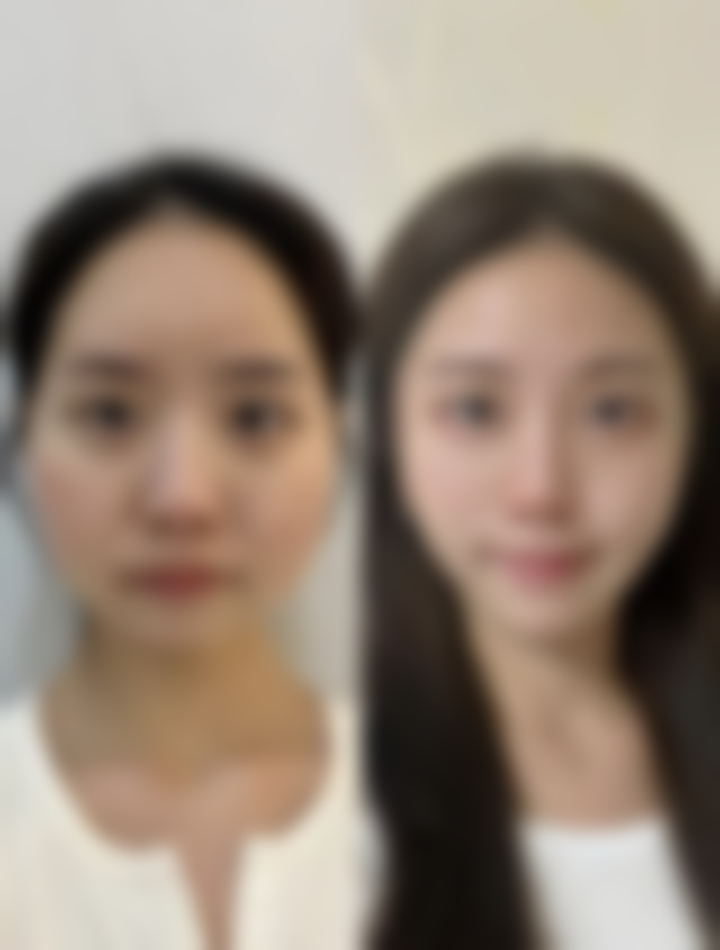 脂肪栓塞：小腿抽脂的重度并发症