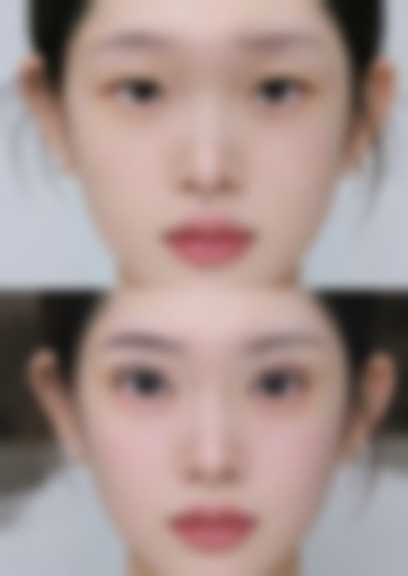 老年人能割眼袋吗——手术风险需知晓