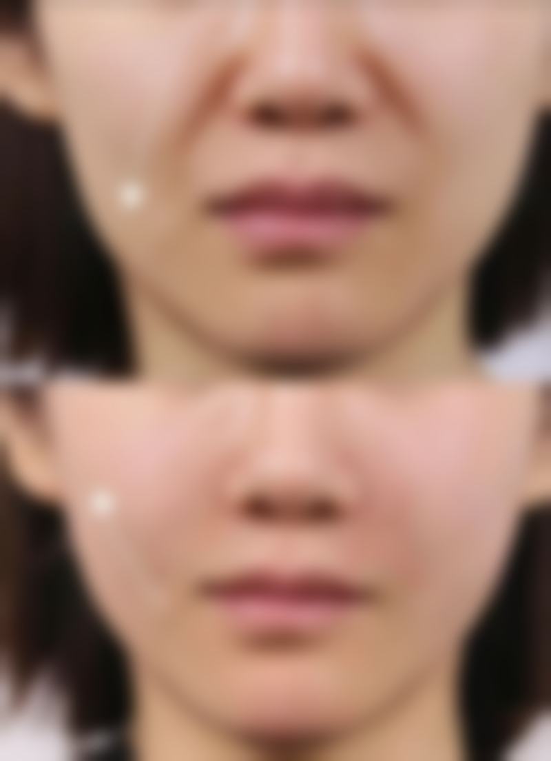 割双眼皮修复手术不同方法的价格能接受吗