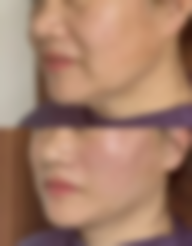 老年人能割眼袋吗——多样手术方法大揭秘