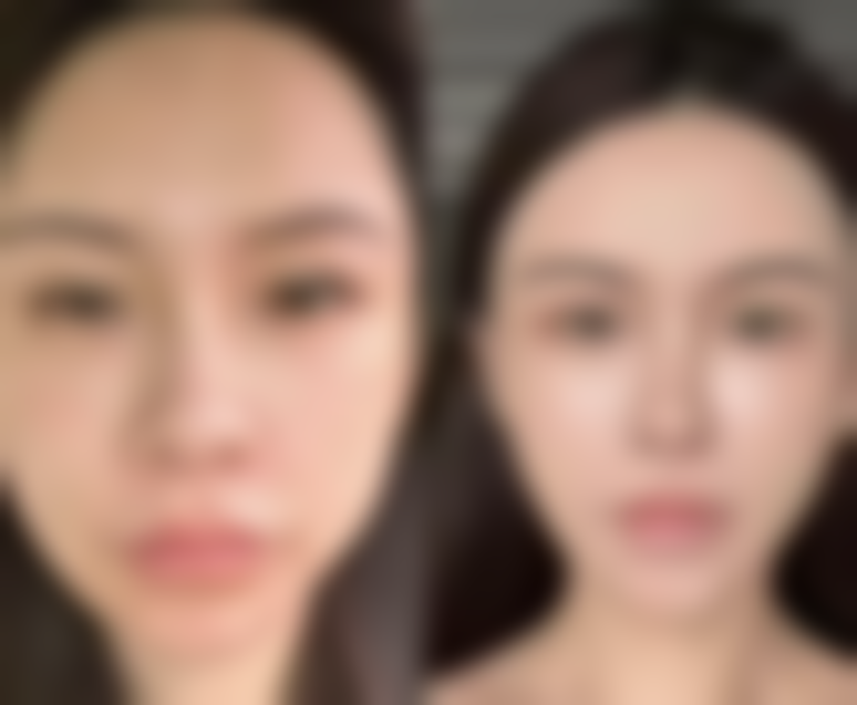 割双眼皮线条不自然或不对称能修复吗