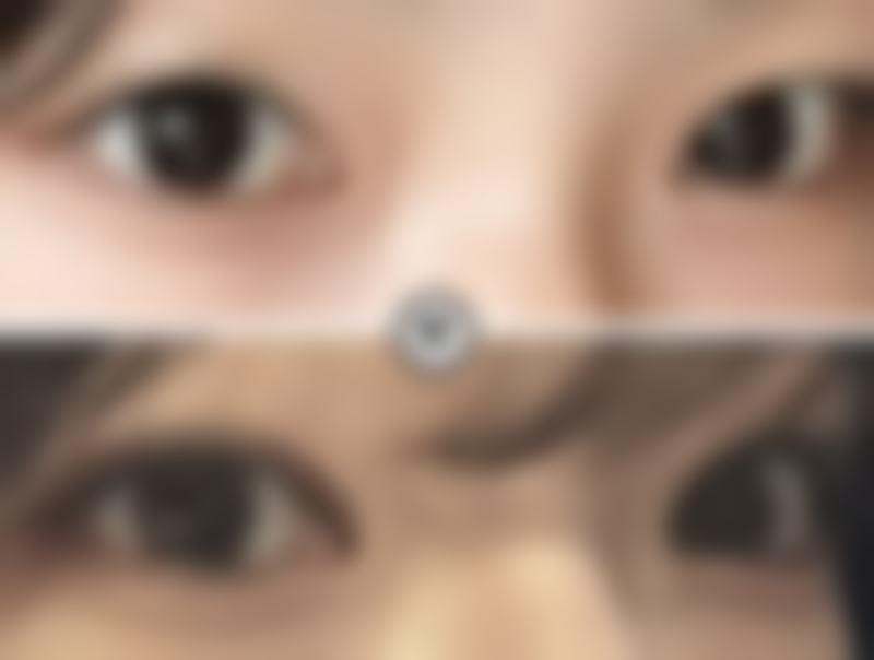 天生的黑眼袋怎么消除——长沙雅美医疗美容医院