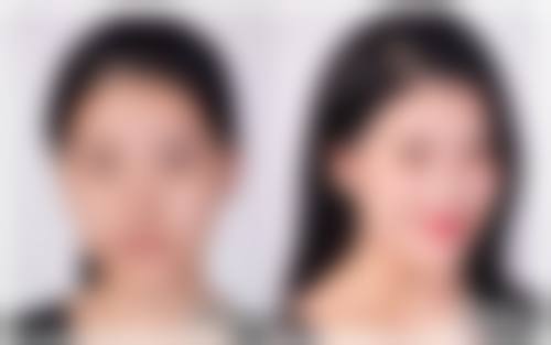 半肋骨隆鼻子是恒久的吗