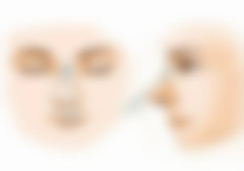 怎么除顽固的眼袋——上海华美医疗美容医院、杭州艺星医疗美容医院