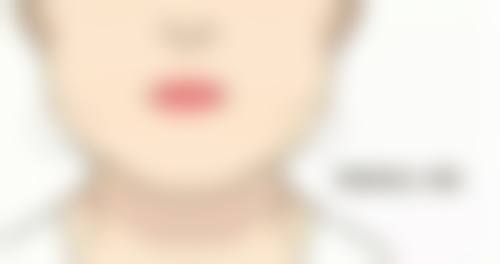 肋软骨隆鼻外观多久修复自然：等待“真香”时刻