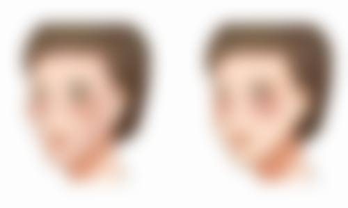 肋软骨隆鼻疼痛多久修复：告别“呼吸都痛”的日子