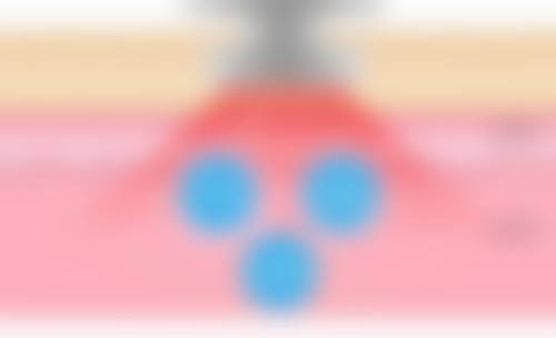 怎么除顽固的眼袋——北京协和医院整形科