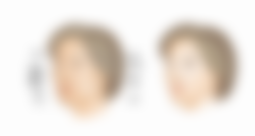 不同类型医院肚子抽脂成效对比之精细抉择参考