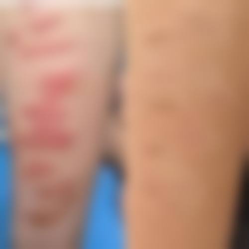 烫伤的疤痕怎么能去掉——武汉美莱